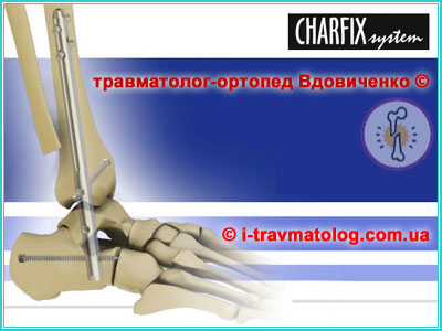 Остеосинтез большеберцовой кости