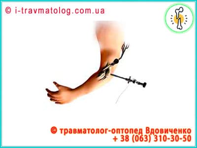 Артроскопия локтевого сустава в Киеве ☎ +38 (063) 310-30-50, Константин Вдовиченко | в клинике №10, ИТО НАМНУ, г. Киев, Украина Артроскопия локтевого сустава в Киеве ☎ +38 (063) 310-30-50, Константин Вдовиченко | в клинике №10, ИТО НАМНУ, г. Киев, Украина