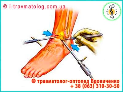 Артроскопия голеностопного сустава в Киеве ☎ +38 (063) 310-30-50, Константин Вдовиченко | в клинике №10, ИТО НАМНУ, г. Киев, Украина
