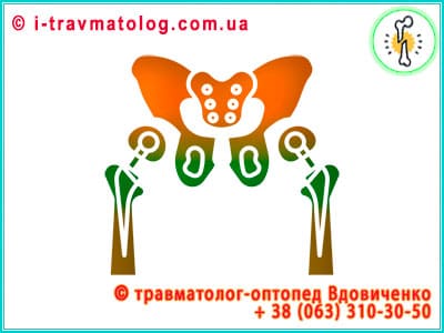 Эндопротезирование тазобедренного сустава в Киеве ☎ +38 (063) 310-30-50, Константин Вдовиченко | в клинике №10, ИТО НАМНУ, г. Киев, Украина