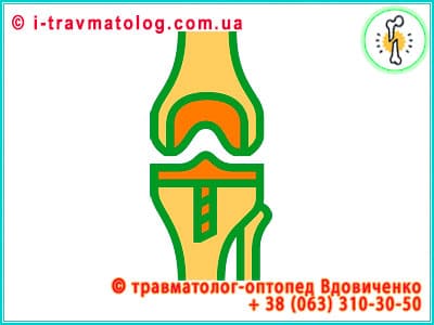Эндопротезирование коленного сустава в Киеве ☎ +38 (063) 310-30-50, Константин Вдовиченко | в клинике №10, ИТО НАМНУ, г. Киев, Украина