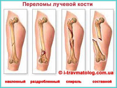 Остеосинтез лучевой кости