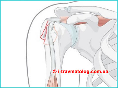 Osteosynthesis of the Humeral Shaft in Kyiv ☎ +38 (063) 310-30-50, Konstantin Vdovichenko | at Clinic No. 10, Institute of Traumatology and Orthopedics of the National Academy of Medical Sciences of Ukraine, Kyiv, Ukraine
